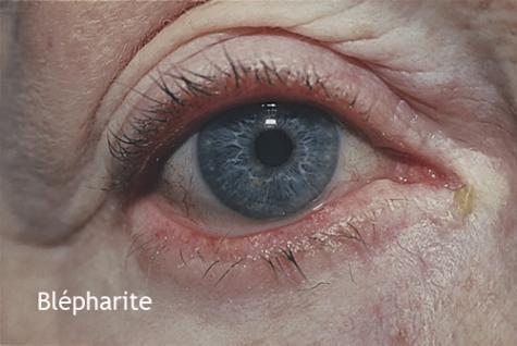 Inflammations de l'oeil  ce que je dois savoir  Le site du Docteur
